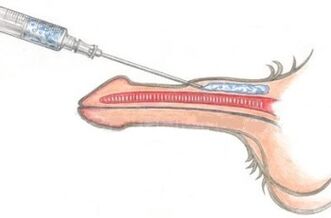 Eng geféierlech Method fir d'Erweiderung vun der Penis mat Vaseline Injektiounen